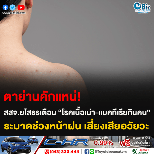 ตาย่านคักแหน่! สสจ.ยโสธรเตือน “โรคเนื้อเน่า-แบคทีเรียกินคน” ระบาดช่วงหน้าฝน เสี่ยงเสียอวัยวะ